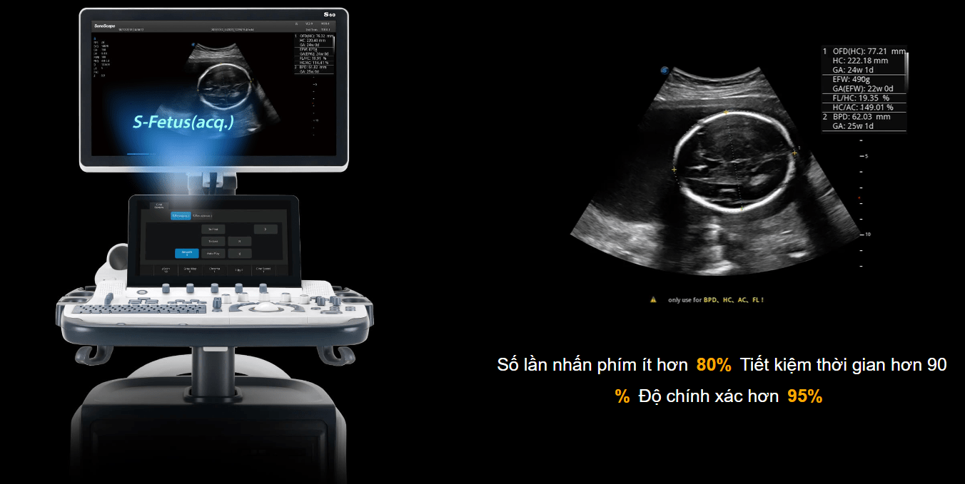 Máy siêu âm 5D/6D Sonoscape S60